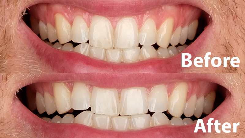 What are 10 brands of teeth whitening kits?